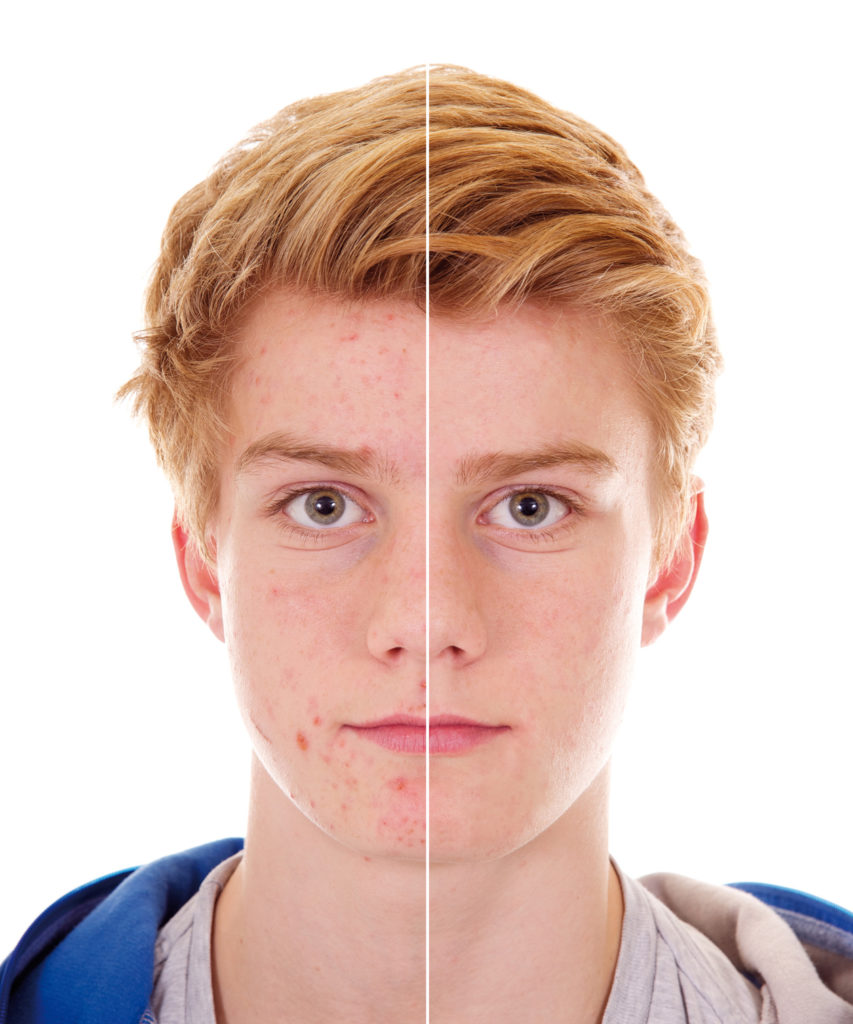 Akne - Die Schönmacherin Regensburg