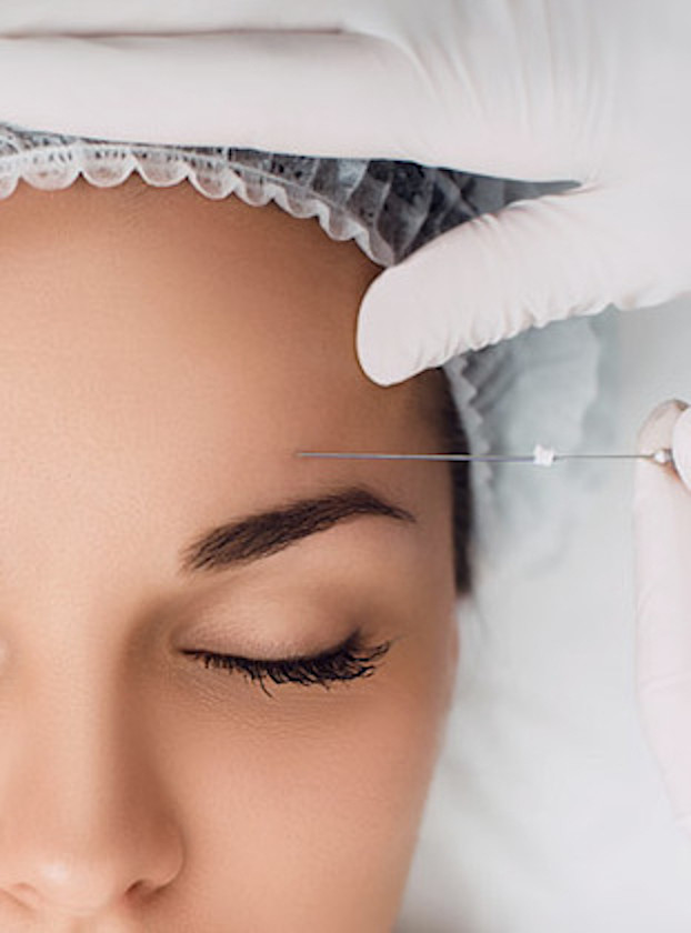 Fadenlifting_Die Schönmacherin Regensburg Fadenlifting Die Schönmacherin Regensburg